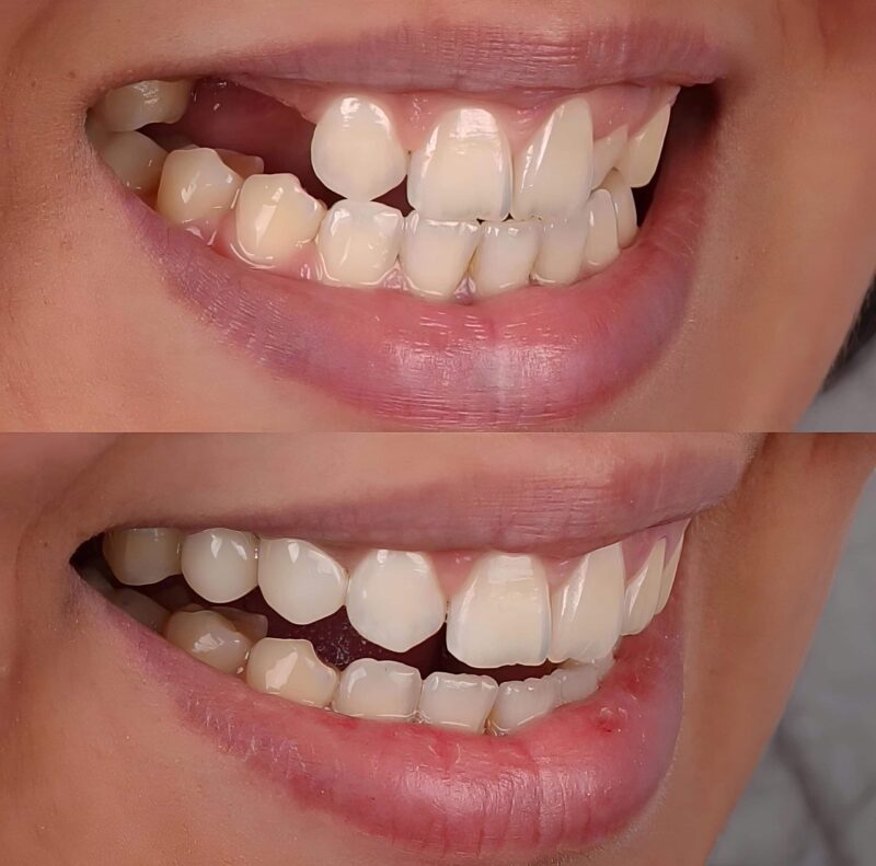 Restorative Dentistry Vancouver