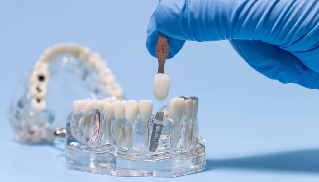 Dental Implants Vancouver